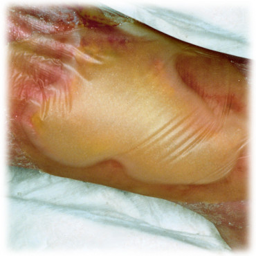 HYDROCOLL Pansament cu hidrocoloid, Hartmann